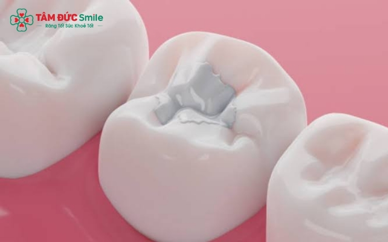 Miếng trám Composite chất lượng cao giúp phục hồi hình thể răng tự nhiên và đảm bảo độ bền tối ưu trong sinh hoạt hằng ngày.