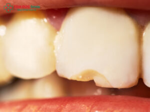 Răng bị mẻ có trám được không?