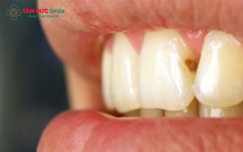 Răng cửa bị sâu nhẹ ở kẽ răng hoàn toàn có thể phục hồi thẩm mỹ bằng phương pháp trám Composite.