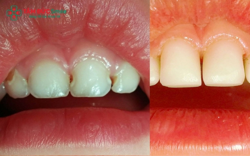 Vật liệu Composite tại Nha khoa Tâm Đức Smile có dải màu đa dạng, giúp miếng trám trông tự nhiên như răng thật.