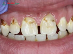 Răng cửa bị sâu có trám được không? Trám răng cửa sâu có bền không?