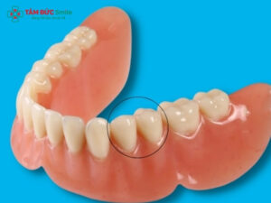 Răng hàm là gì? Cấu tạo và chức năng của răng hàm