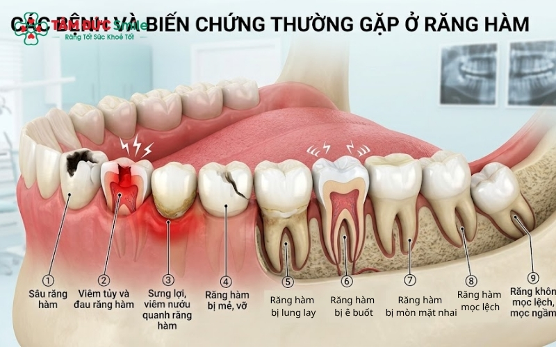Minh hoạ chi tiết các bệnh và biến chứng thường gặp ở răng hàm 
