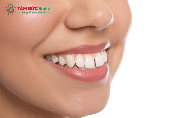 Răng hô có thể xuất phát từ di truyền, sự phát triển xương hàm hoặc những thói quen xấu từ khi còn nhỏ.