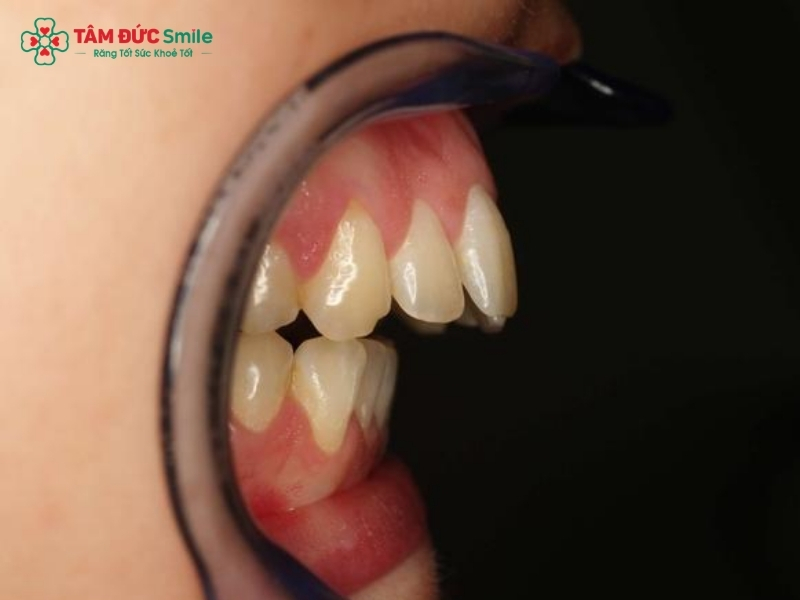 Răng hô là gì? Nguyên nhân, ảnh hưởng và cách điều trị răng hô hiệu quả
