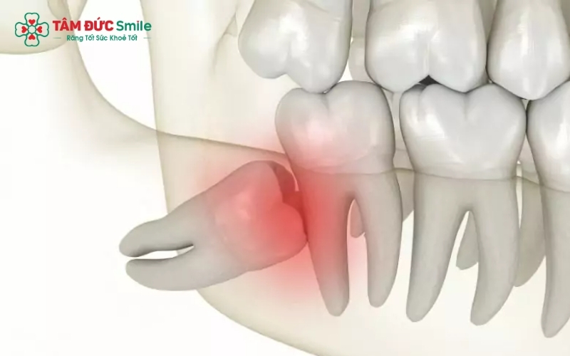 Răng khôn mọc nghiêng là dấu hiệu phổ biến khiến người bệnh đau nhức và khó chịu