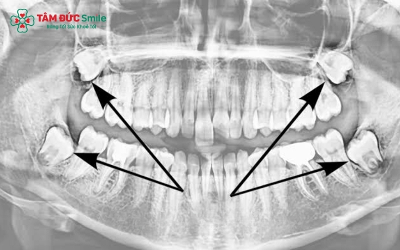 Các kiểu răng khôn mọc lệch phổ biến cần được bác sĩ nha khoa đánh giá mức độ phức tạp.