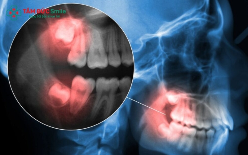 Răng khôn mọc lệch nếu không xử lý sớm có thể gây sâu răng số 7 và ảnh hưởng đến sức khỏe răng miệng toàn hàm