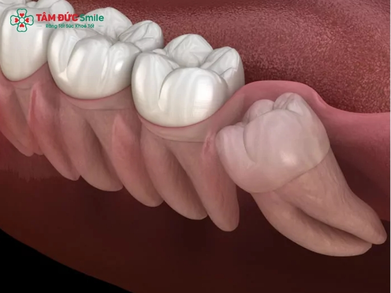 Răng khôn mọc lệch: Dấu hiệu, biến chứng và cách xử lý an toàn