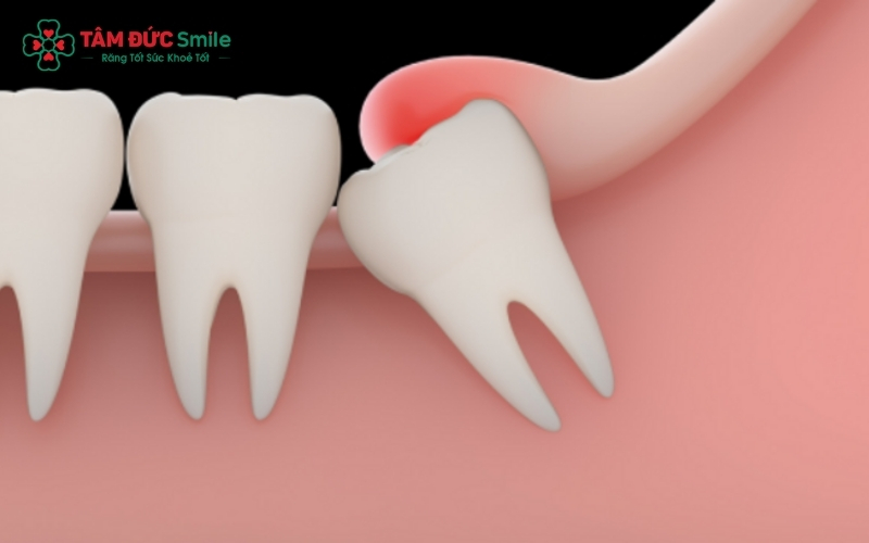 Xác định chính xác hướng mọc của răng khôn, từ đó đưa ra quyết định có cần nhổ bỏ hay không.