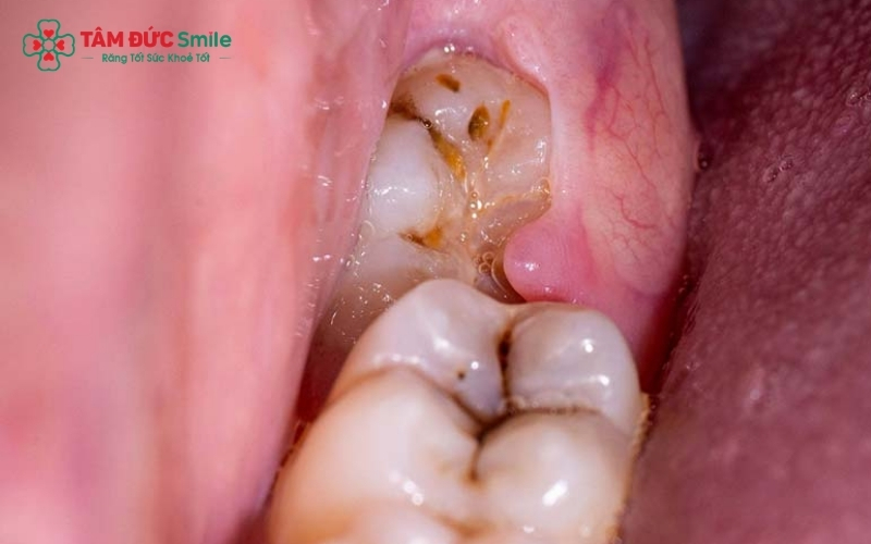 Răng khôn mọc lệch tạo thành "bẫy thức ăn", nếu để lâu sẽ gây sâu răng kế cận và viêm nhiễm nghiêm trọng