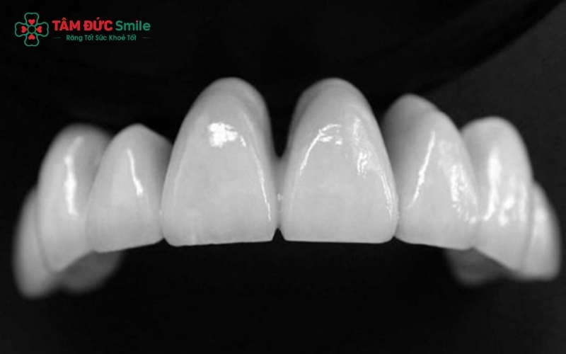 Răng sứ Cercon là dòng răng toàn sứ cao cấp với cấu tạo không kim loại, giúp loại bỏ hoàn toàn tình trạng bóng đen vùng cổ răng