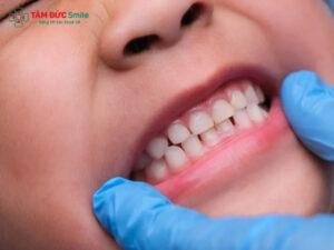 Răng sữa là gì? Lịch mọc, thay răng và cách chăm sóc răng sữa cho trẻ 