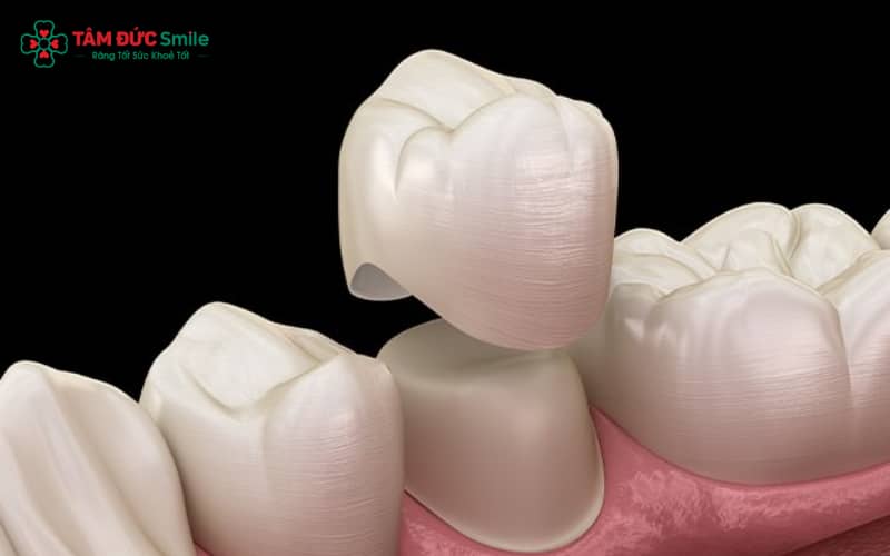 Răng toàn sứ có cấu trúc đồng nhất, mang lại vẻ đẹp tự nhiên và bền chắc