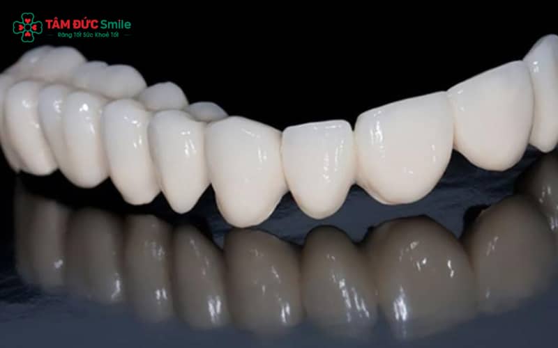 Răng toàn sứ Emax Press có tính thẩm mỹ tự nhiên, nụ cười hoàn hảo