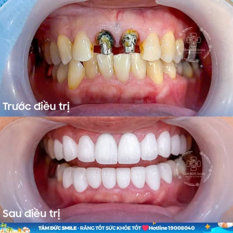 Độ bền cao và thẩm mỹ tối ưu với răng toàn sứ