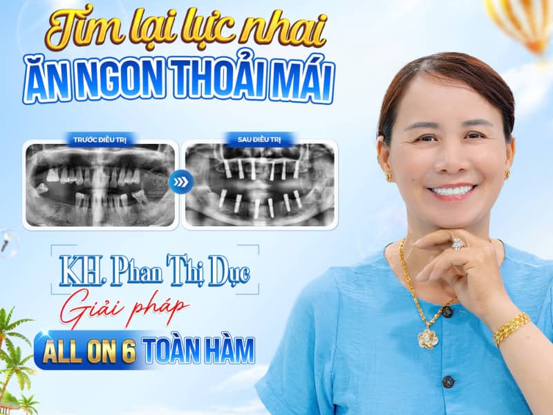 Răng toàn sứ phù hợp với Quý khách muốn thay thế răng cũ bị hư tổn hoặc đổi màu