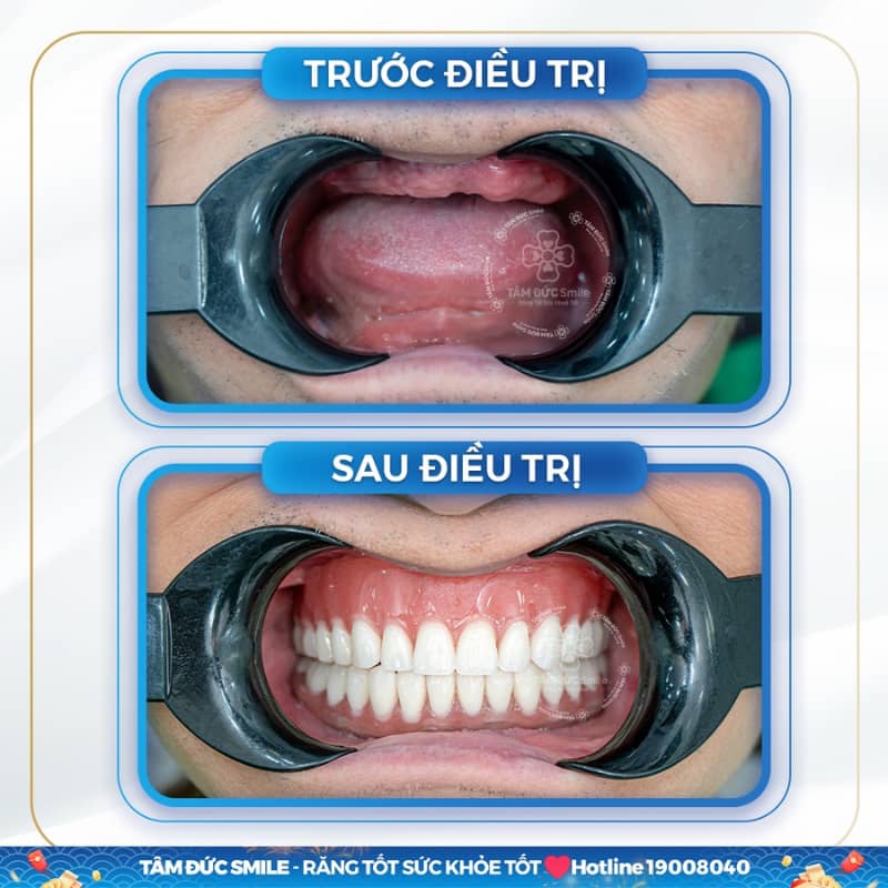 Sau điều trị, cảm giác ê nhẹ chỉ xuất hiện ở hầu hết Quý khách từ 1–2 ngày đầu