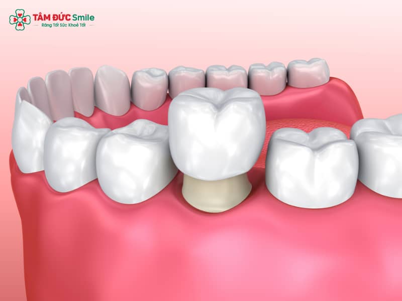 Răng toàn sứ là gì? Giá bao nhiêu, có đau không và nên chọn loại nào tốt nhất?