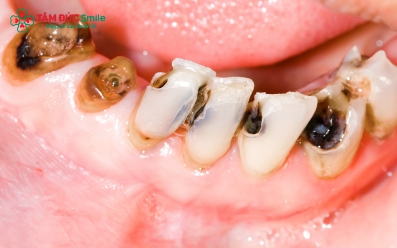 Sâu răng là quá trình tiến triển âm thầm, nếu không điều trị sớm sẽ gây ra những biến chứng khó lường.