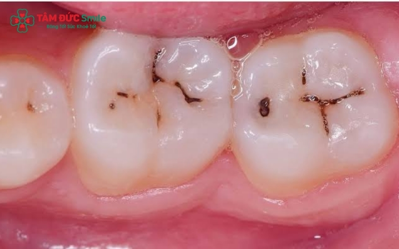 Lỗ sâu trên bề mặt răng, đau nhức khi ăn nóng/lạnh là những dấu hiệu cảnh báo bạn cần đến nha khoa ngay.