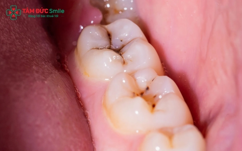 Các đốm đen hoặc lỗ sâu trên mặt nhai là dấu hiệu cho thấy mô răng hàm đang bị vi khuẩn phá hủy