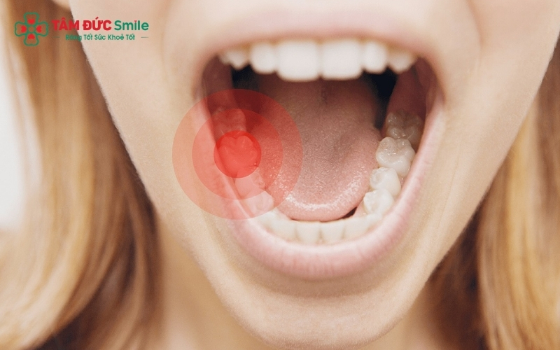 Sâu răng hàm nếu không điều trị sớm sẽ dẫn đến viêm tủy, áp xe chân răng và nguy cơ mất răng vĩnh viễn.