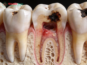 Sâu răng hàm: Dấu hiệu, cách điều trị và phòng ngừa sâu răng hàm