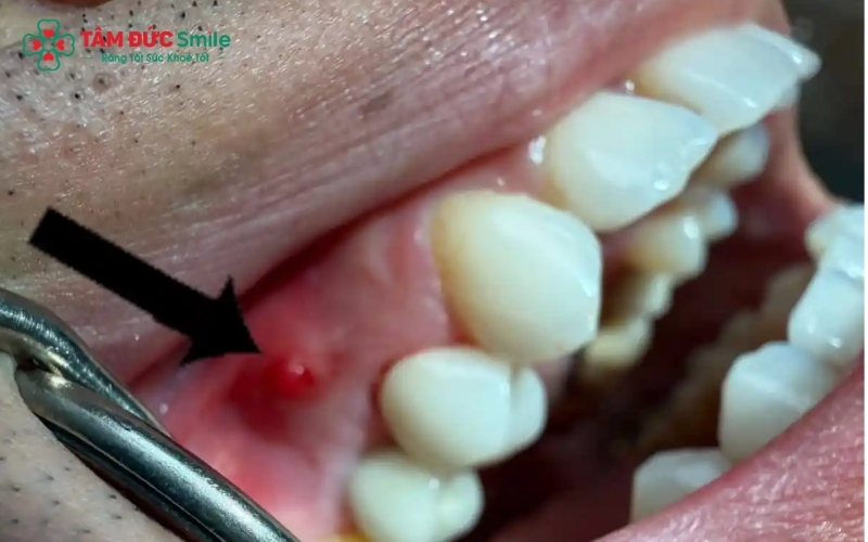 Sâu răng nặng nếu không điều trị kịp thời sẽ gây viêm tủy, áp xe và nguy cơ mất răng vĩnh viễn rất cao.