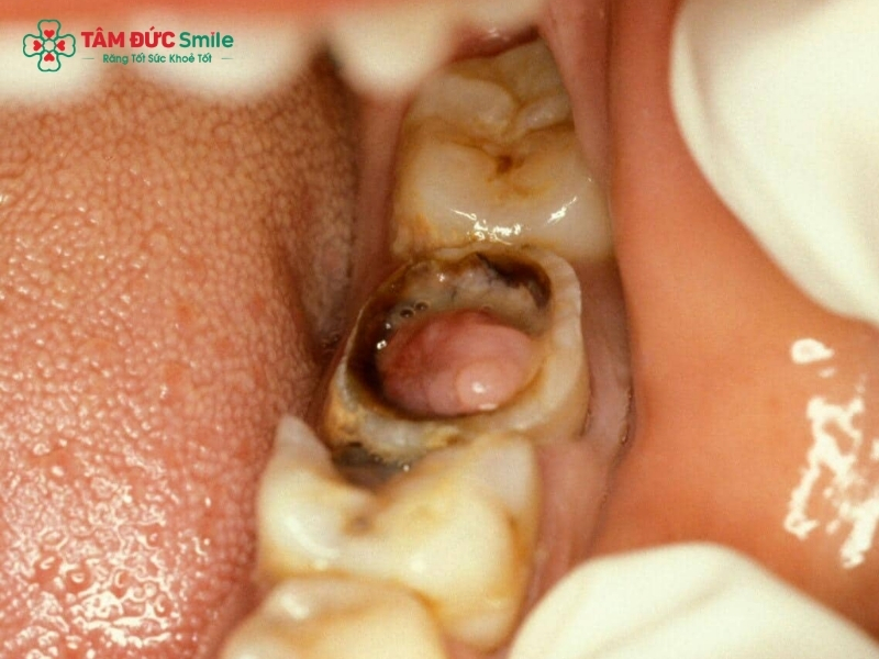 Sâu răng nặng: Dấu hiệu, tác hại và cách điều trị