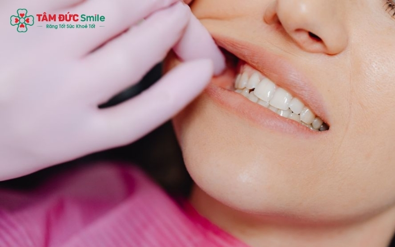 Tẩy trắng răng bằng công nghệ hiện đại tại nha khoa chỉ tác động lên phân tử màu, không gây bào mòn hay tổn thương men răng.