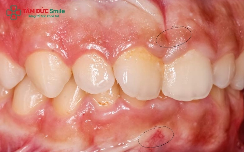 huốc tẩy trắng nồng độ cao khi tiếp xúc trực tiếp có thể gây bỏng rát và kích ứng mô nướu.