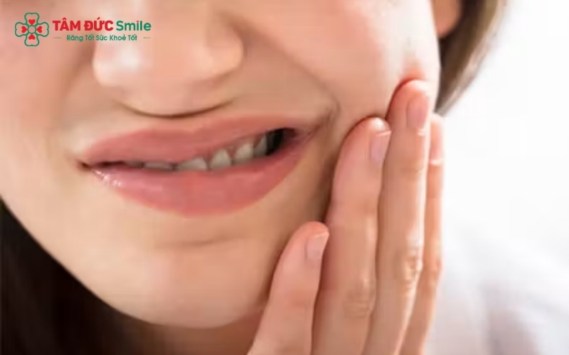 Ê buốt nhẹ là phản ứng tạm thời khi thuốc tẩy tác động vào cấu trúc răng, thường sẽ biến mất sau 24 - 48 giờ.