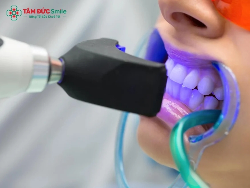 Tẩy trắng răng có hại không?