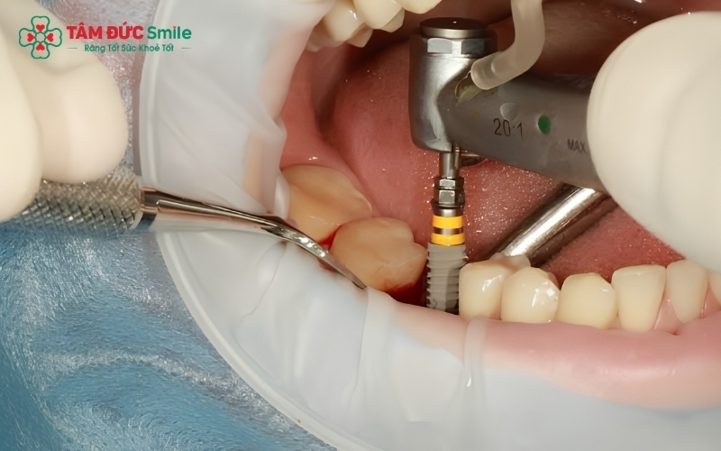 Với công nghệ gây tê hiện đại và kỹ thuật chuyên môn cao, quá trình đặt trụ Implant diễn ra nhẹ nhàng, khách hàng hầu như không cảm thấy đau đớn