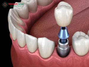 Trồng răng Implant có đau không? Sau khi trồng răng Implant bao lâu hết đau?
