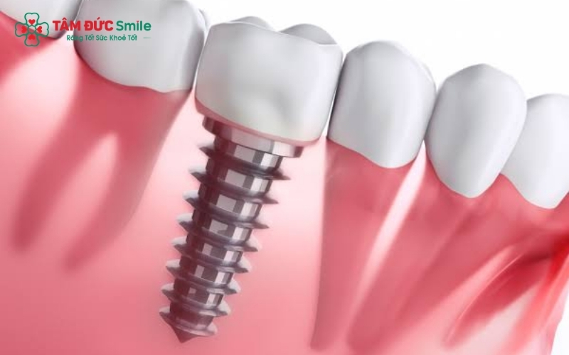 Cấu trúc 3 phần vững chắc của Implant giúp phục hồi cả chân và thân răng, mang lại khả năng chịu lực và cảm giác ăn nhai như răng thật.