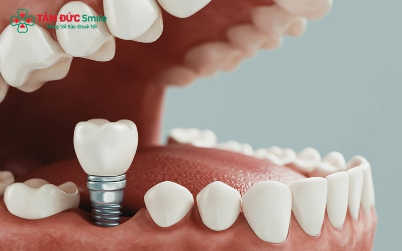 So với cầu răng sứ truyền thống, cấy ghép Implant vượt trội nhờ khả năng bảo tồn răng thật tối đa và ngăn ngừa tình trạng tiêu xương hàm.