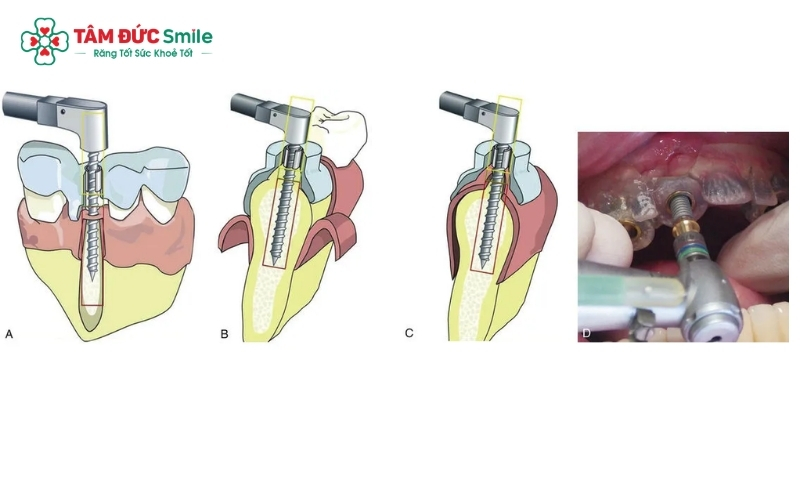 Răng Implant được thiết kế riêng biệt để đảm bảo sự hài hòa, tự nhiên và độ bền vững lâu dài theo thời gian