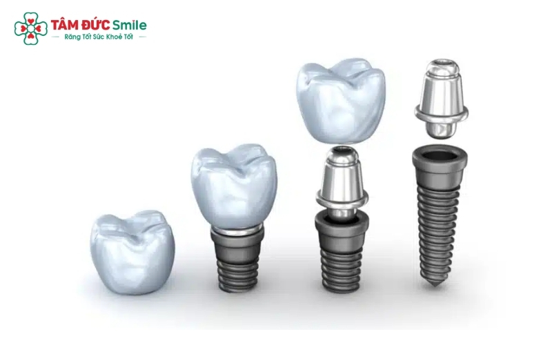Sự khác biệt giữa các loại trụ nằm ở công nghệ xử lý bề mặt và thiết kế ren, quyết định tốc độ lành thương và khả năng chịu lực nhai lâu dài.