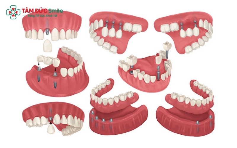 Việc lựa chọn loại trụ Implant nào phụ thuộc rất lớn vào mật độ xương và vị trí mất răng cụ thể của từng khách hàng.