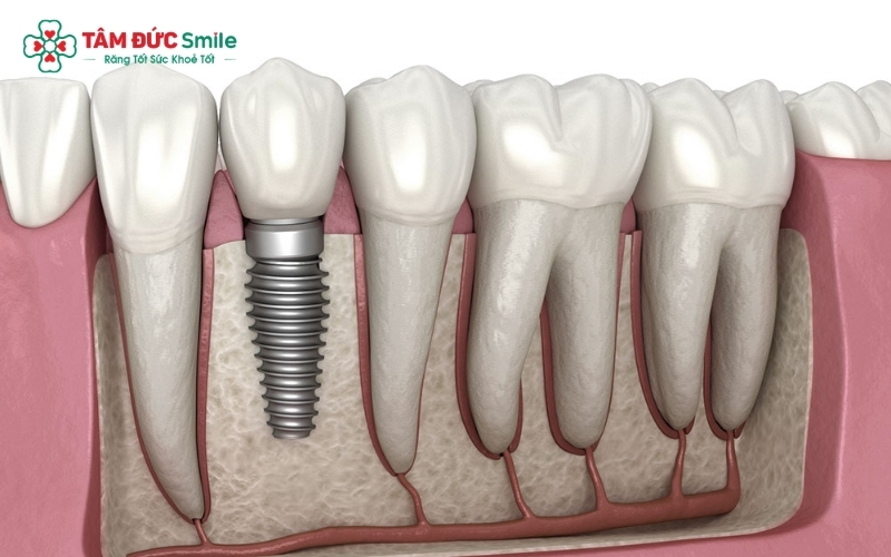 Cấu tạo 3 phần của răng Implant giúp phục hồi hoàn chỉnh cả chân răng và thân răng đã mất