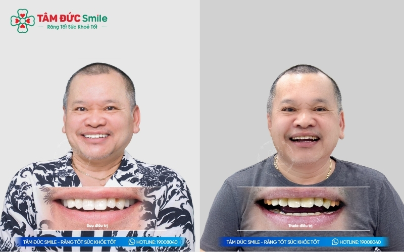 Răng Implant có màu sắc tự nhiên và độ chịu lực cao, giúp khách hàng tự tin giao tiếp và ăn nhai thoải mái.