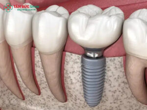 Ưu nhược điểm của trồng răng Implant. Có nên trồng răng Implant không?