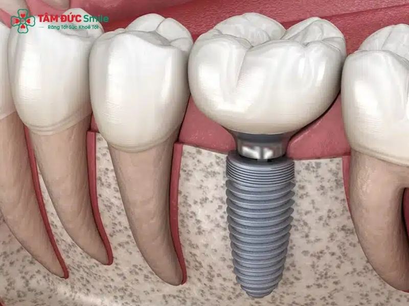 Ưu nhược điểm của trồng răng Implant. Có nên trồng răng Implant không?