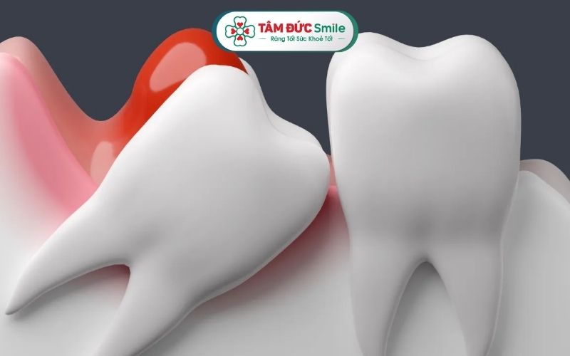 Viêm lợi trùm răng khôn là hiện tượng khá phổ biến ở người trong độ tuổi từ 17-25