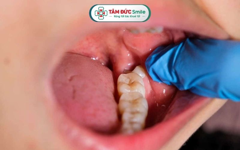 Có nhiều nguyên nhân có thể gây viêm lợi trùm răng khôn như răng mọc ngầm, vệ sinh răng miệng kém, miễn dịch yếu...