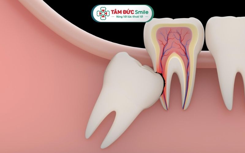 Nếu không điều trị sớm, viêm lợi trùm răng khôn có thể gây biến chứng nguy hiểm