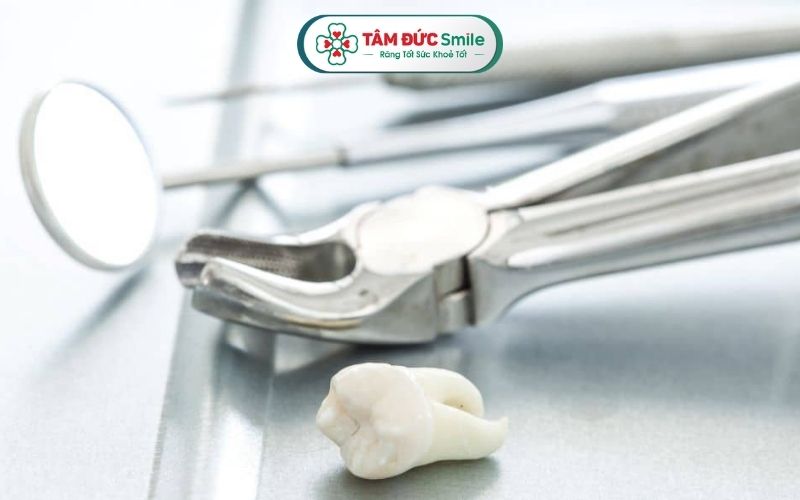 Nên nhổ răng khôn chỉ có chỉ định từ phía bác sĩ