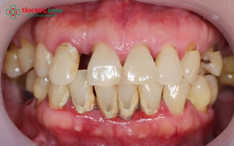 Răng bị viêm nha chu với tình trạng nướu bị tách rời khỏi chân răng và tiêu xương ổ răng.